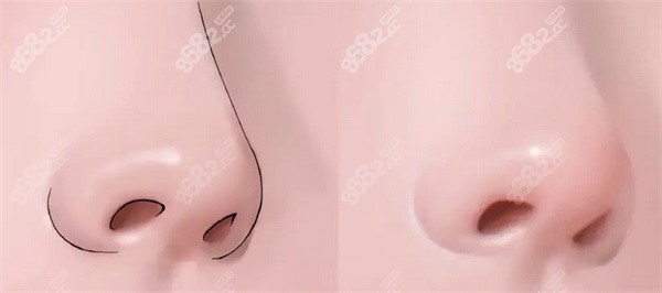 害怕隆鼻后不好看
