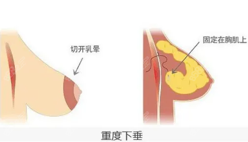 乳房下垂手术方式