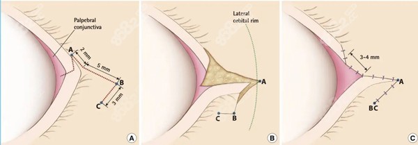 修复外眼角手术原理
