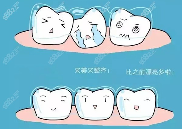 牙齿矫正可以只矫两颗正门牙吗
