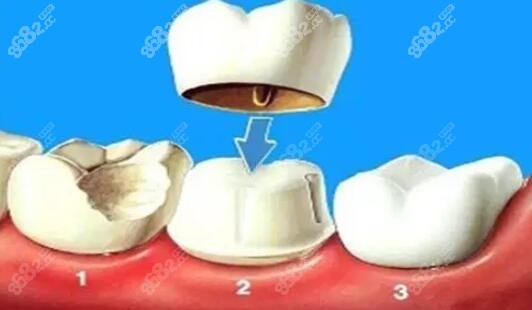 根管治疗后牙齿矫正