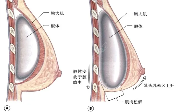 美国特贝茨隆胸技术