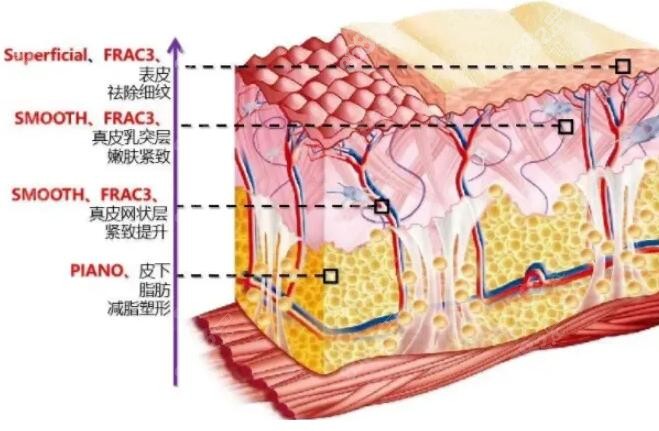 激光除皺和注射除皺哪個好？
