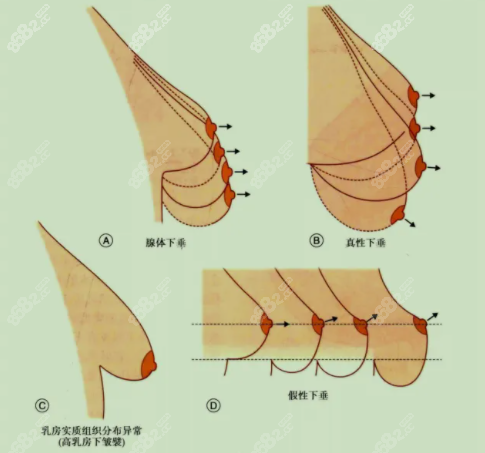 乳房下垂的类型