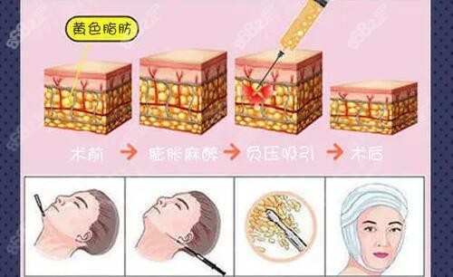 黄金微雕吸脂