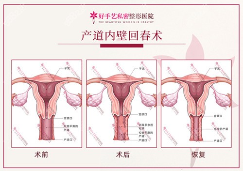 韩国好手艺私密整形医院手术缩阴