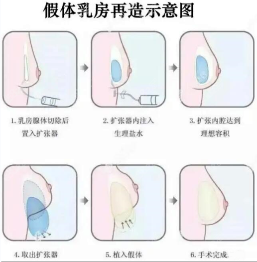 曹勇假体乳房再造手术图示