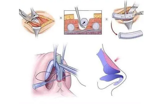 www.8682.cc提供的肋骨鼻综合手术过程图