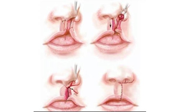 唇腭裂整形修复手术