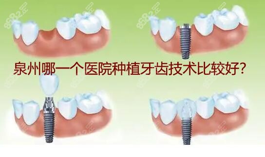 泉州哪一个医院种植牙齿技术比较好？