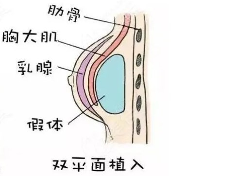 谭新东医生做假体丰胸双平面放置层次