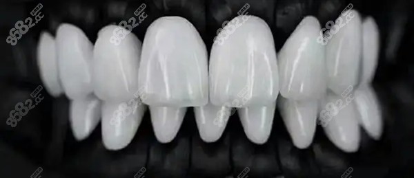 昆明牙齿贴面多少钱一颗？