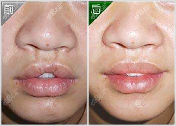 唇腭裂整形可以修复成正常吗