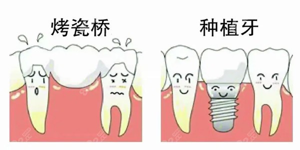 种植牙和固定搭桥哪种好？