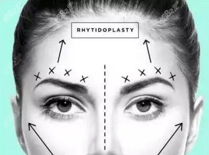 额头提升术能改善眉眼间距近吗