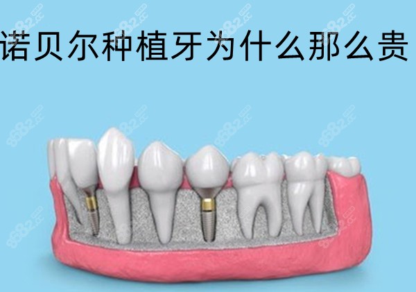 诺贝尔种植牙为什么那么贵