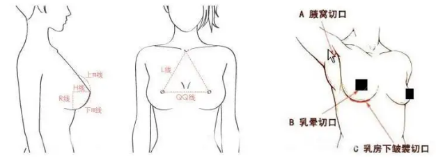 假体隆胸后乳房中间很宽怎么改善