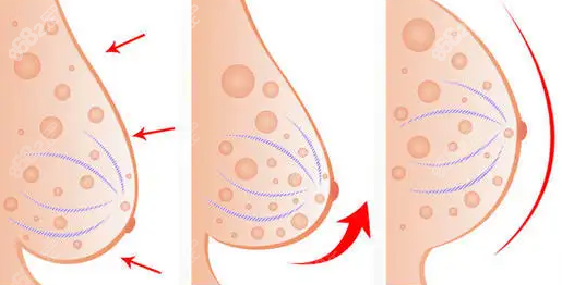 乳房下垂矯正示意圖