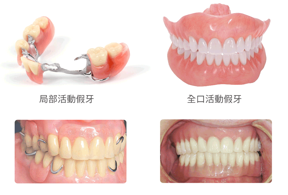 活动假牙和搭桥哪个好