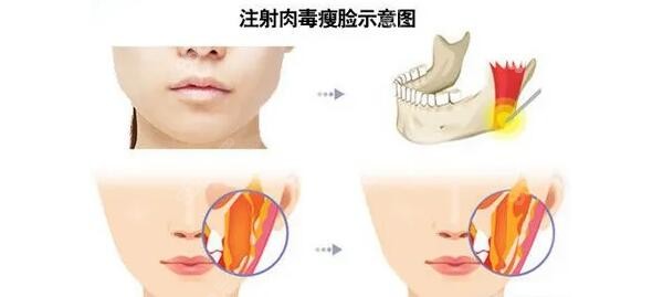 轮廓针和瘦脸哪个贵