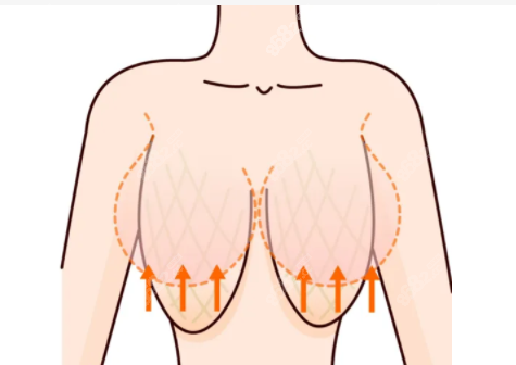 郭广科可以做乳房提升