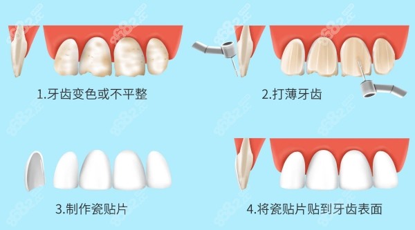 牙齿贴面的修复过程图解
