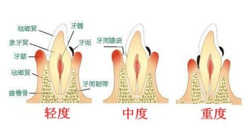 牙周炎症状程度决定了价格