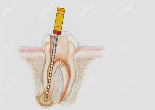 根管治疗