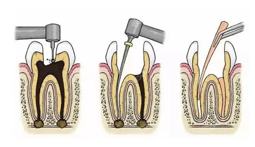 根管治疗