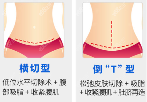 腹壁成型术切口位置图解