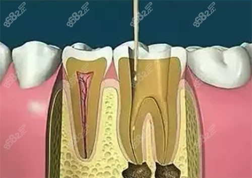 根管治疗前后对比图片