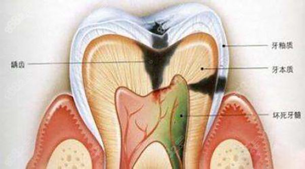 對於淺齲蛀牙,一般只需要進行補牙就可以,將齲化壞掉的牙體組織去除後