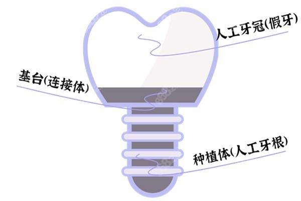 杭州临安区种植牙多少钱一颗