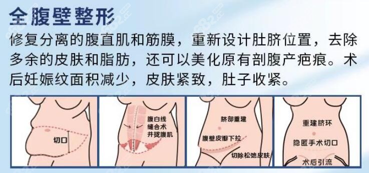 重庆全腹壁整形修复价格