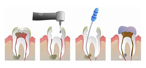 根管治疗