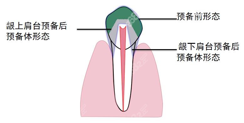 瓷贴面粘接步骤的技术要点