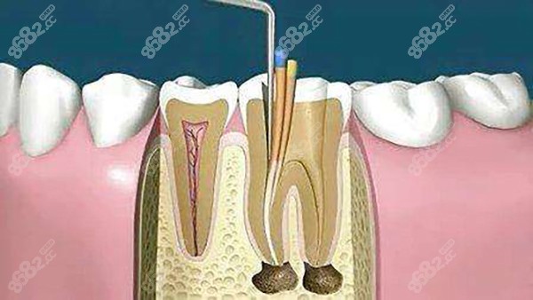 根管治疗