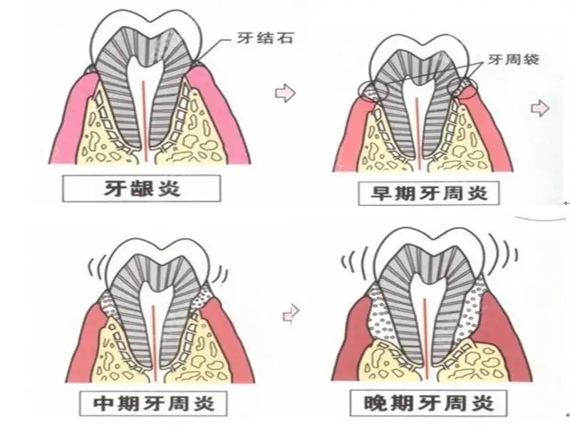 牙周炎治疗的费用是根据诊疗情况