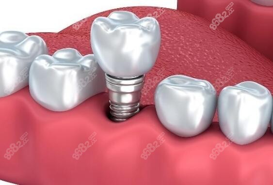 牙周炎做假牙的成功率高