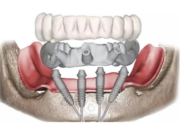 半口all on 4种植牙的图