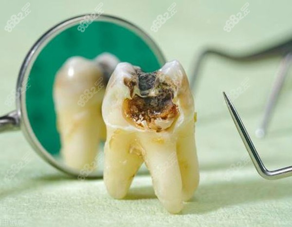 烂到牙根的牙补牙图片图片