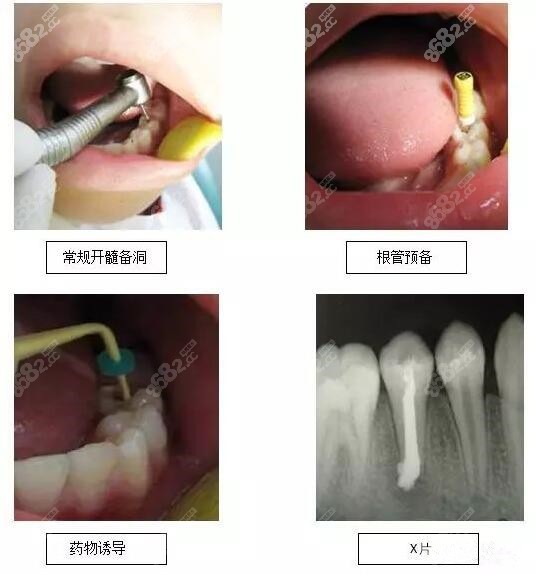 孩子做根尖诱导成形术多少钱