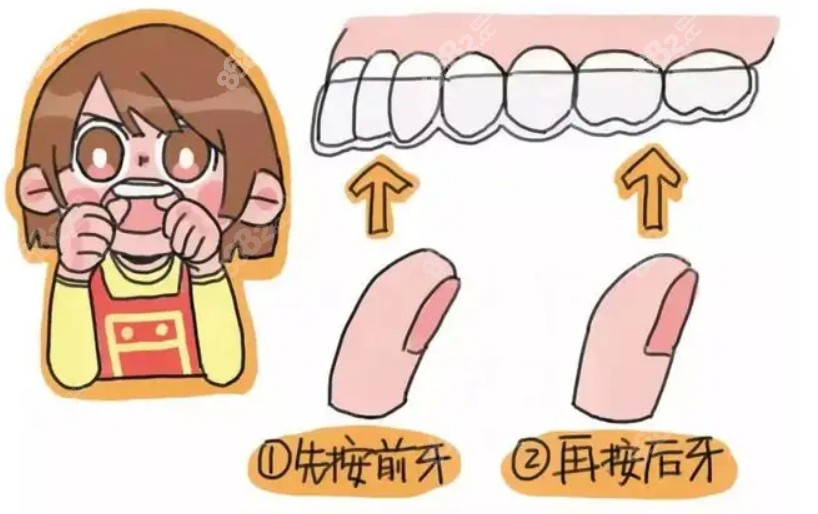 隐形矫正佩戴方法