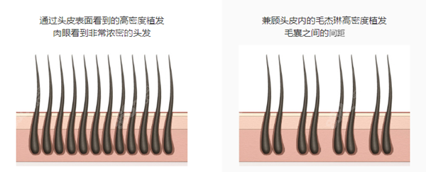 韩国毛杰琳植发毛囊兼具对比