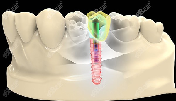 长春医院牙科种植牙