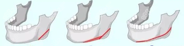 切除下颌角手术三种方法