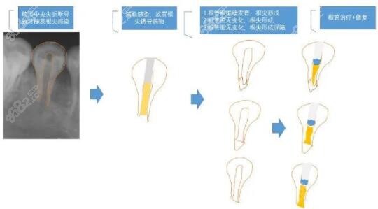 根尖诱导成型术示意图