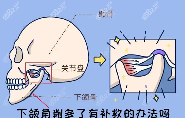 下颌角削多了有补救的办法吗