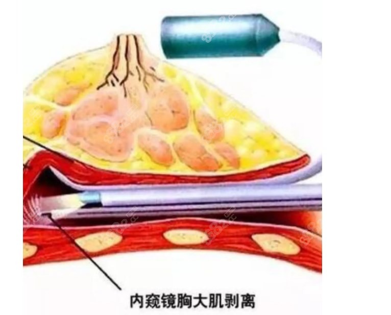 广州黄广香医生隆胸有使用内窥镜