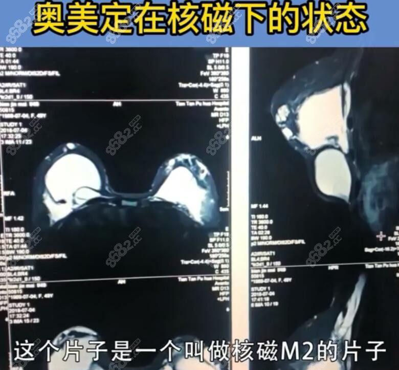 奥美定在核磁共振下的样子